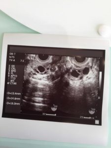 卵胞の超音波検査写真